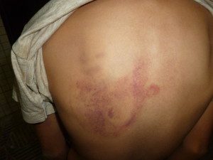 Marcas da agressão ficaram nas costas da menina
